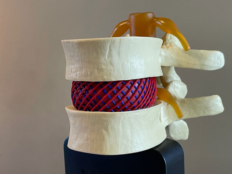 modelo de hernia lumbar conn fibras cruzadas del disco intervertebral